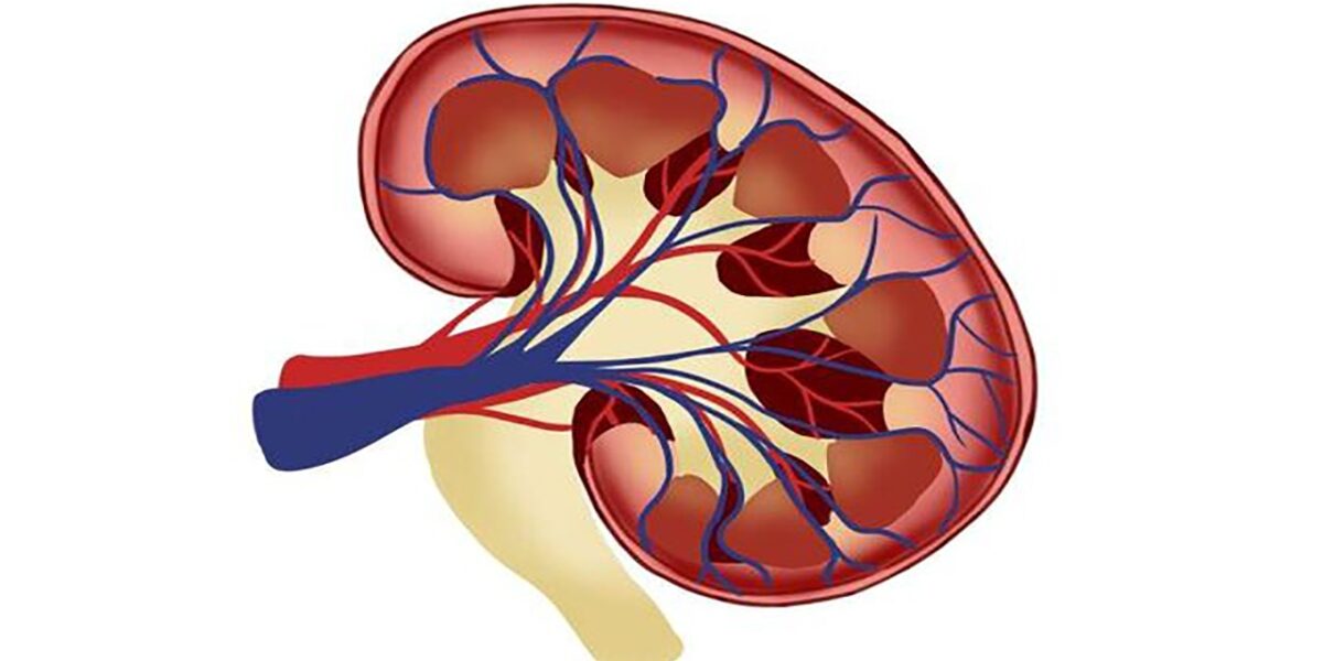 علائم، درمان و باور‌های غلط درباره سنگ کلیه