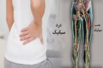 سیاتیک را با گرفتگی عضلات اشتباه نگیرید