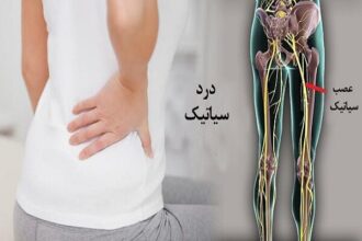 سیاتیک را با گرفتگی عضلات اشتباه نگیرید