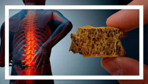 علل پوکی استخوان؛ از کم‌وزنی تا دخانیات و الکل