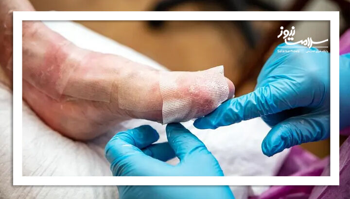 درخواست خانواده‌های بیماران ای‌بی از دولت گام‌های مؤثر برای رفع دغدغه‌های درمانی و دارویی بیماران پروانه‌ای