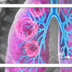 فناوری هسته‌ای؛سلاحی نوین برای تشخیص سرطان ریه