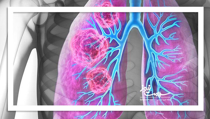 فناوری هسته‌ای؛سلاحی نوین برای تشخیص سرطان ریه