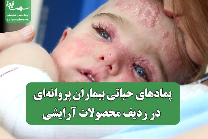 پمادهای حیاتی بیماران پروانه‌ای در ردیف محصولات آرایشی؛ هزینه‌های درمانی بالا و نیاز به اصلاح سیاست‌های بیمه‌ای