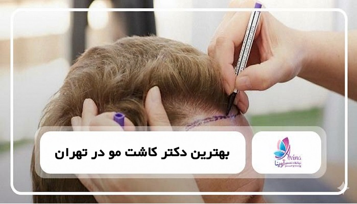 بهترین دکتر کاشت مو در تهران