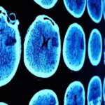 چه کسانی بیشتر در معرض خطر تومورهای مغزی هستند