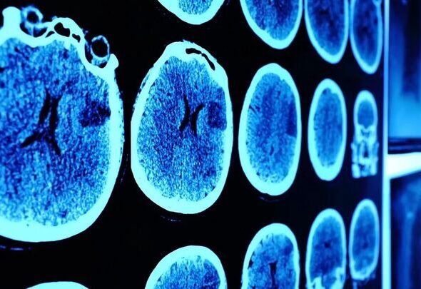 چه کسانی بیشتر در معرض خطر تومورهای مغزی هستند