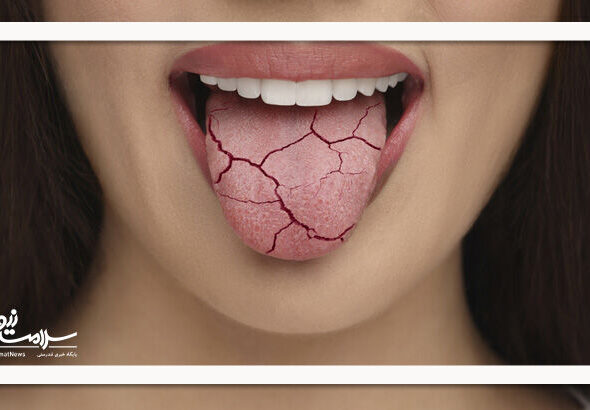 ۱۰ راه ساده برای خلاص شدن از خشکی دهان