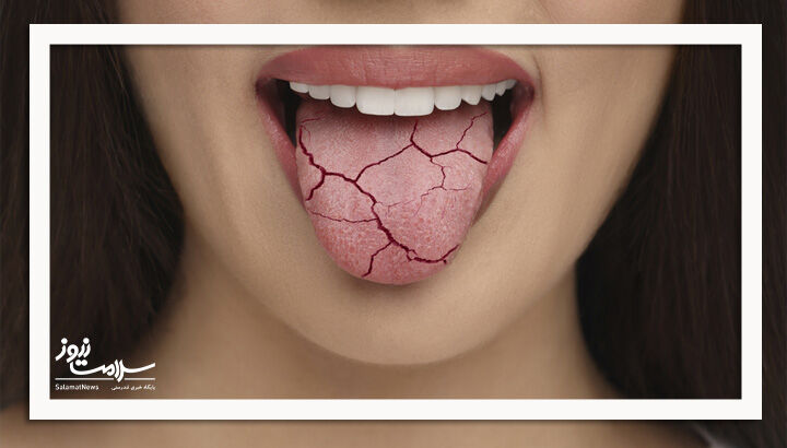 ۱۰ راه ساده برای خلاص شدن از خشکی دهان