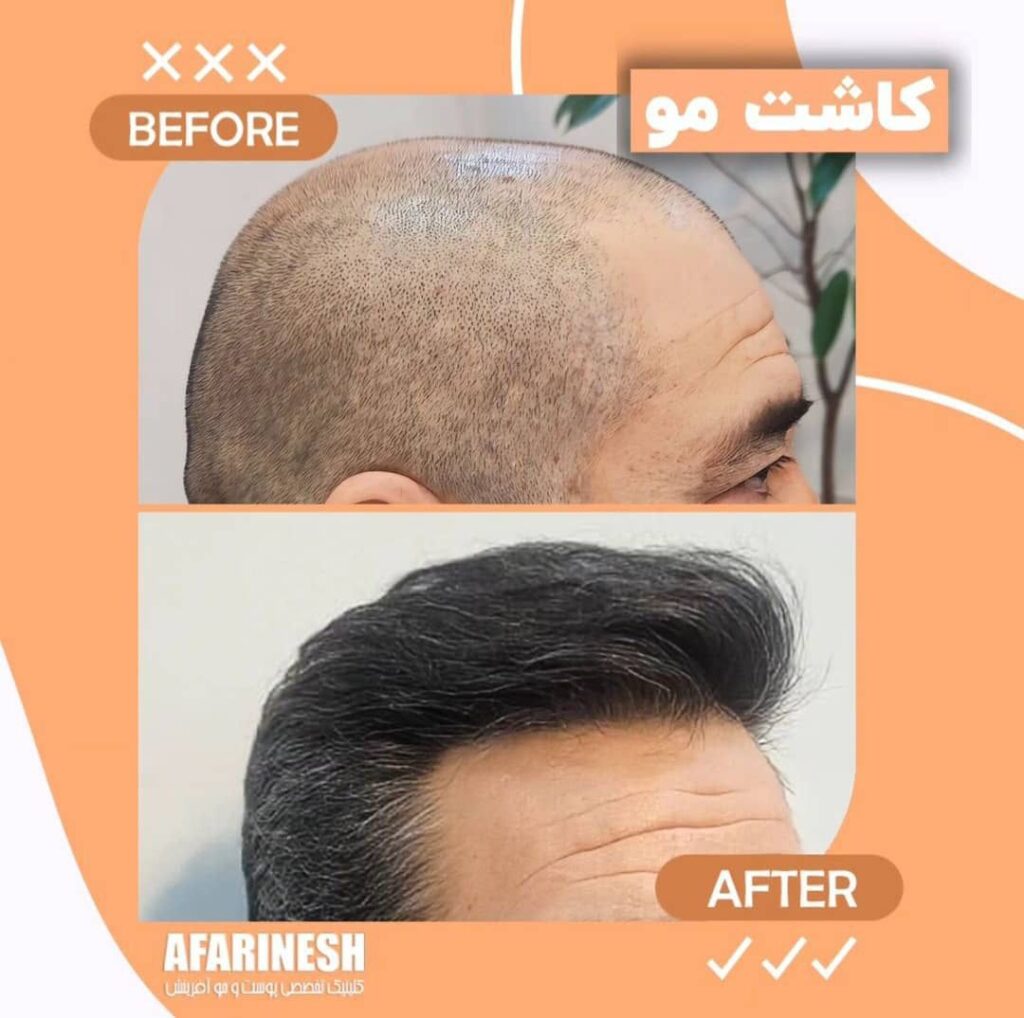 بهترین کلینیک کاشت مو در مشهد راهنمای کامل انتخاب مرکز تخصصی کاشت مو تصویر 1