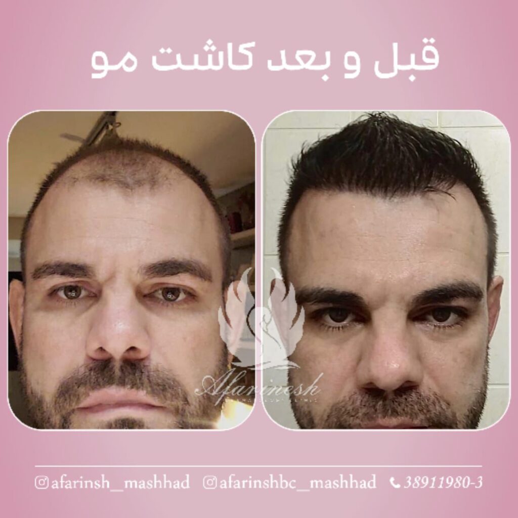 بهترین کلینیک کاشت مو در مشهد راهنمای کامل انتخاب مرکز تخصصی کاشت مو تصویر 2