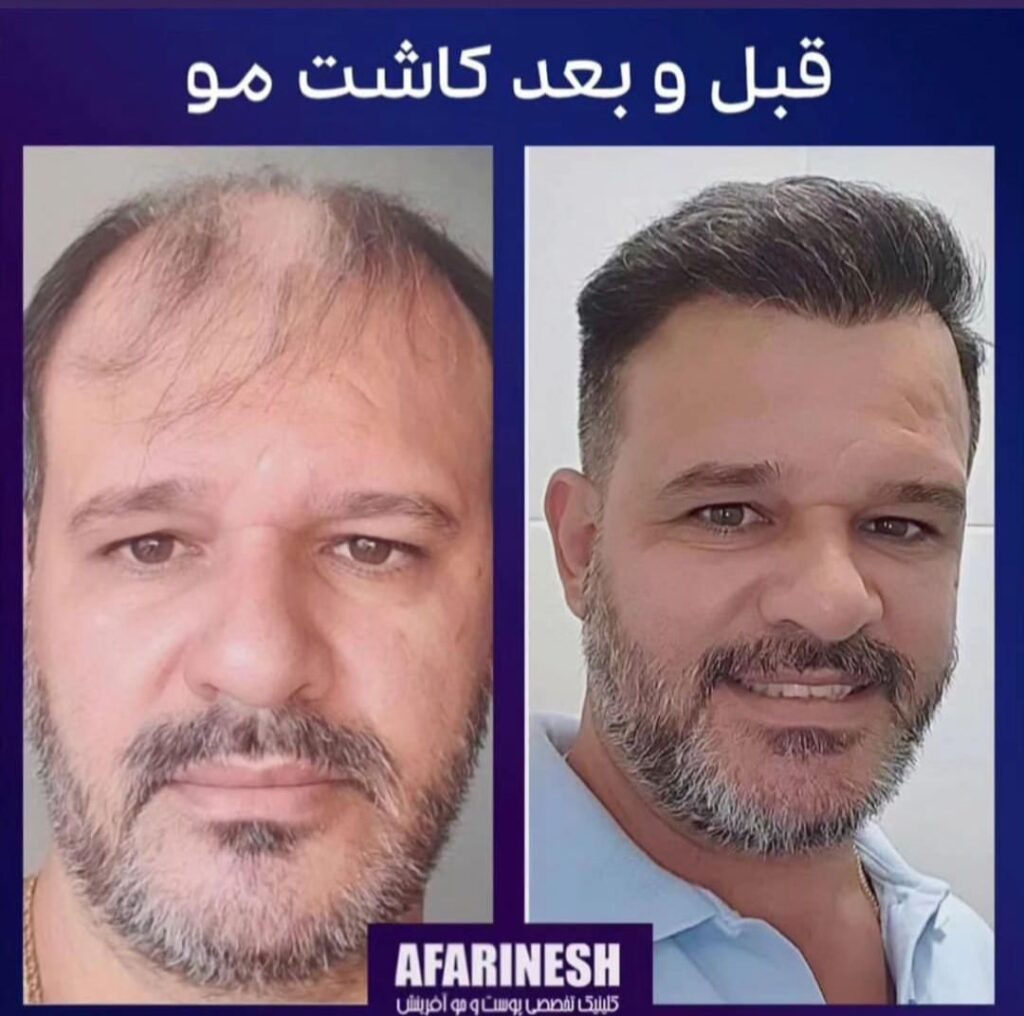 بهترین کلینیک کاشت مو در مشهد راهنمای کامل انتخاب مرکز تخصصی کاشت مو تصویر 3